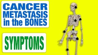 Cancer Metastasis in the Bones  All Symptoms [upl. by Kciredor]