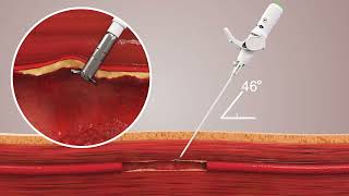 Celt ACD  Vascular Closure Device  Vasorum Ltd [upl. by Ennaej970]