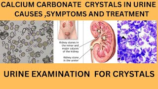 CALCIUM CARBONATE CRYSTALS IN URINECAUSES SYMPTOMS TREATMENT OF CALCIUM CARBONATE STONES [upl. by Efinnej26]