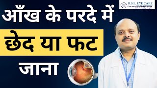 आँख के परदे में छेद या फट जाना  Barrage Laser for Retina Holes and Lattice Degeneration Treatment [upl. by Hew]