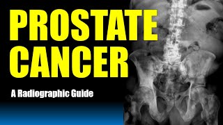 Prostate Cancer Metastasis  A Radiographic Guide radiology xray doctor [upl. by Moreen]