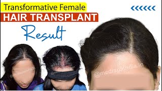 Female Hair Transplant Results in India  Medispa Hair Transplant India [upl. by Shulem]