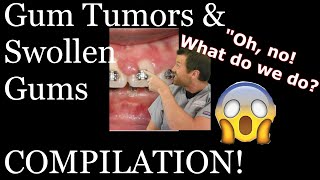 Braces causing gum tumorsswollen gums compilation [upl. by Ocsinarf121]