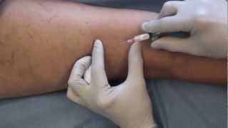 SyrEase Foam Sclerotherapy [upl. by Arval234]