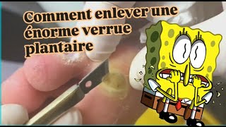 Comment enlever une énorme verrue plantaire [upl. by Akemehs950]