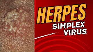 HERPES IN MALAYALAM  Symptoms Who What amp When To Test Treatments Fact Check Stages amp Testing [upl. by Nameerf]