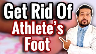 How to Treat Athletes Foot FOR GOOD 2021 [upl. by Nomma824]