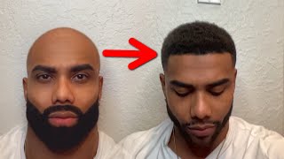 How To Keep Your Hairline Forever Anti Balding Routine [upl. by Beverly]