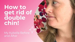 My Kybella Before and After  How to Get Rid of Double Chin [upl. by Marja]