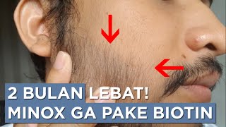 Progres Minoxidil 2 Bulan Tanpa Biotin [upl. by Nilkoorb]