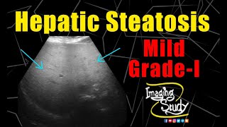 Mild Hepatic Steatosis  GradeI Fatty Liver  Ultrasound  Case 226 [upl. by Luoar]