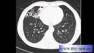 CT Chest  How to differentiate between pulmonary arteries and veins [upl. by Antonio333]