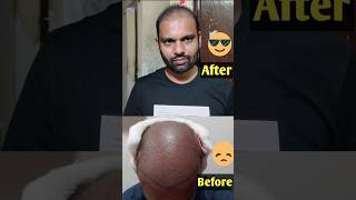 Hair Transplant 100 Days Journey  Hair transplant result [upl. by Natsyrk]