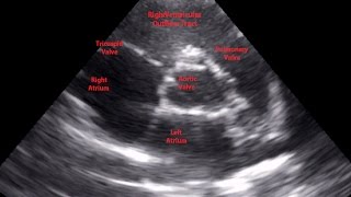 Parasternal Short Axis View Aortic Level  Loop [upl. by Jollenta]