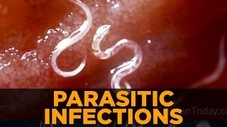 Parasitic Infections amp Symptoms From Parasites [upl. by Chancelor]