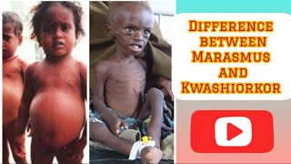 Marasmus and Kwashiorkor difference between marasmus and Kwashiorkor hindi pediatricnursing [upl. by Pardo]