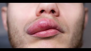 Angioedema  Symptoms and Causes [upl. by Malik]