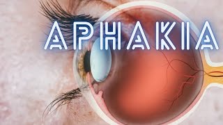 Aphakia  Ophthalmology Lecture [upl. by Edorej411]