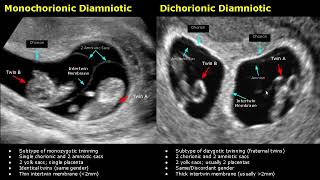 Fetal Twins Ultrasound Normal Vs Abnormal  MonochorionicDichorionicDiamnioticMonoamniotic USG [upl. by Tesler317]