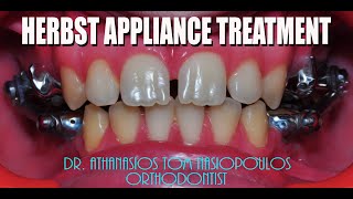 Herbst appliance treatment Case PL  Athanasios Ton Nasiopoulos Orthodontist [upl. by Heimlich]