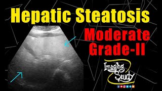 Moderate Hepatic Steatosis  GradeII Fatty Liver  Ultrasound  Case 222 [upl. by Pawsner608]