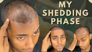 Shedding Phase  My Shedding Phase after 20 Days of Hair Transplant  Krishna Yadav Hair Transplant [upl. by Nowd308]