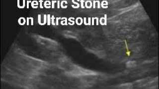 Ureteric stone on Ultrasound [upl. by Ecidnarb]