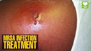 MRSA Infection Treatment  Health Tips  Education [upl. by Aesoh625]