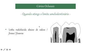 Aspectos Radiográficos Cárie Dental Aula 2  Classificação Radiográfica das Lesões de Cárie [upl. by Devora]