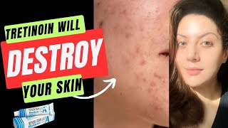 How to Apply Tretinoin Cream I Tretinoin Journey I Tretinoin Side Effects [upl. by Halfon59]