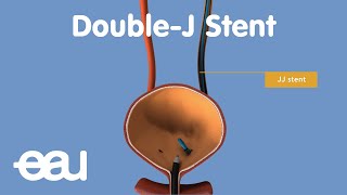 JJ Stent removal of kidney stones [upl. by Norrie]