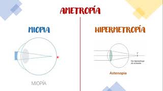 ¿POR QUÉ OCURRE LA MIOPIA Y OTROS DEFECTOS REFRACTIVOS PERLAS MÉDICAS [upl. by Desdamonna533]