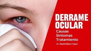 3 CAUSAS DE DERRAME OCULAR 😱 QUE DEBO HACER [upl. by Domash]