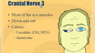 Neuro  Cranial Nerve 3 Palsy [upl. by Retrak234]