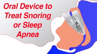 Mandibular Advancement Device MAD to Treat Snoring and Sleep Apnea [upl. by Atikan]