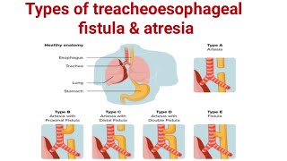 Types of treacheoesophageal fistula amp Atresia ll TEF ll pediatrics ll medical education [upl. by Reyna]