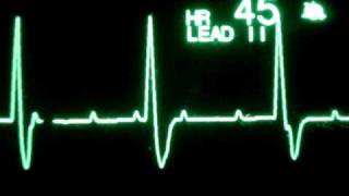 3rd Degree Atrioventricular Block [upl. by Anaid]