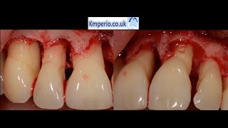 Periodontal Surgery with Regeneration for Upper Teeth [upl. by Markson470]