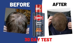 I used quotAlpecin Caffeine Shampooquot for 30 days Heres what happened [upl. by Fries354]