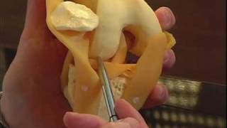 Dr Lonner Explains Total vs Partial Knee Replacement Surgery [upl. by Zosima]