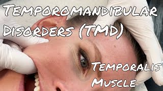 TMJ Pain  Temporalis Release  Motion Specific Release [upl. by Acino]