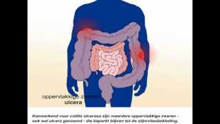 Colitis ulcerosa  Wat zijn de symptomen en behandeling van colitis ulcerosa [upl. by Coppinger]