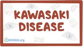 Kawasaki disease  an Osmosis Preview [upl. by Nylesor980]