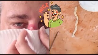 Ultimate Acne Pimple Popping Extractions Clear Skin Revealed [upl. by Huan]