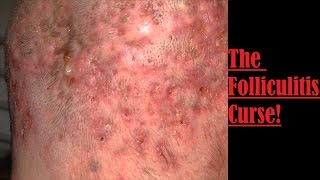 The Folliculitis Curse [upl. by Jankey]