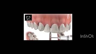 INTERPROXIMAL REDUCTION ipr 🦷  ORTHODONTICS  BRACES [upl. by Alleras320]