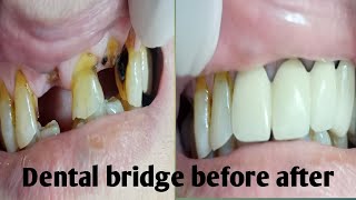 Fix dental bridge before and after [upl. by Nirej]