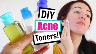 DIY Toner For Acne amp Oily Skin Home Remedies For Acne [upl. by Nauqat]