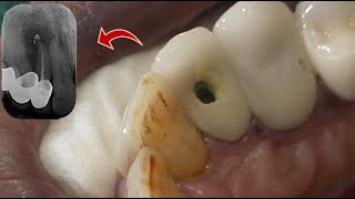 Root Canal Treatment of Maxillary Lateral Incisor Through The Crown [upl. by Cardie]