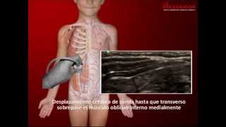 BLOQUEO SEMILUNAR PARA CIRUGÍA ABDOMINAL SEMILUNAR BLOCK FOR ABDOMINAL SURGERY [upl. by Dyolf]